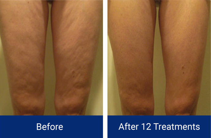 Body Contouring