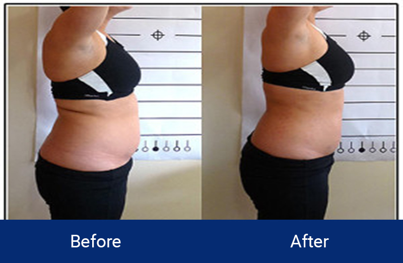 Body Contouring