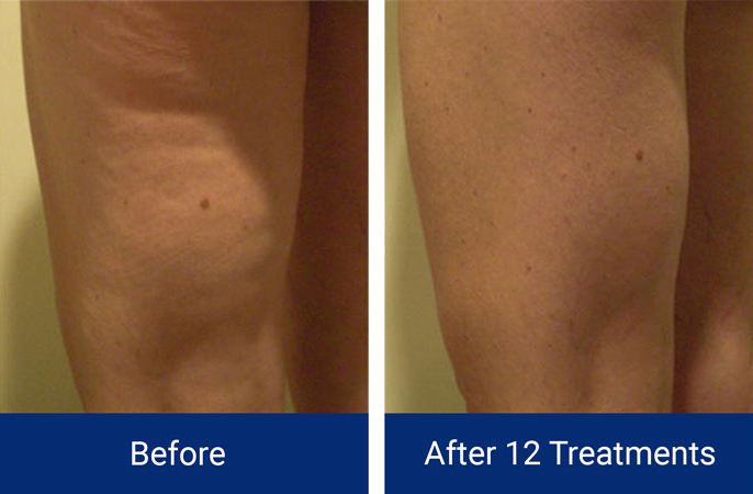 Body Contouring