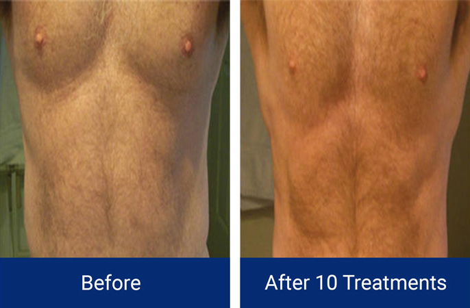 Body Contouring