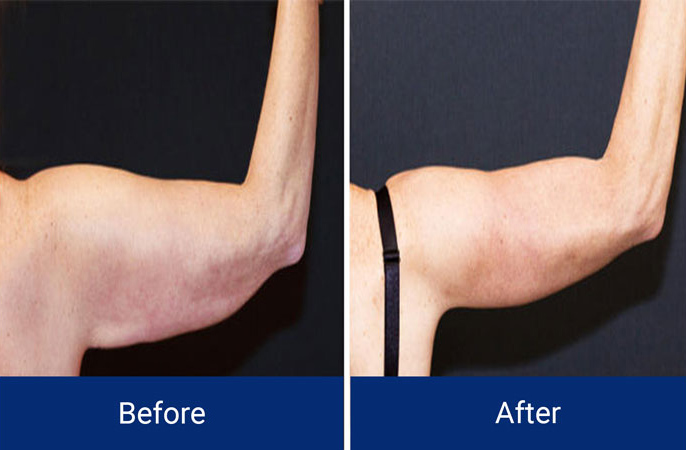 Body Contouring