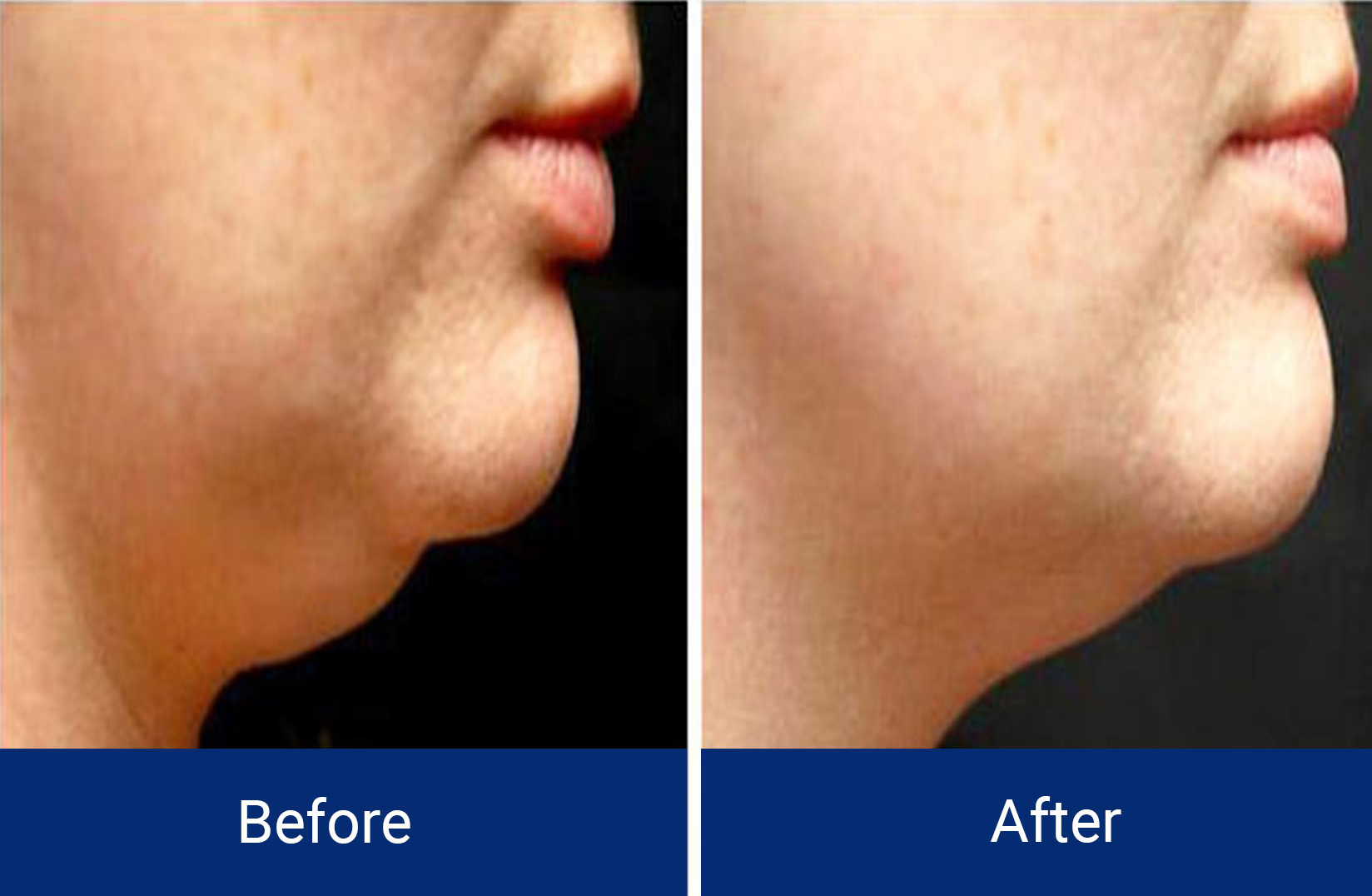 Body Contouring