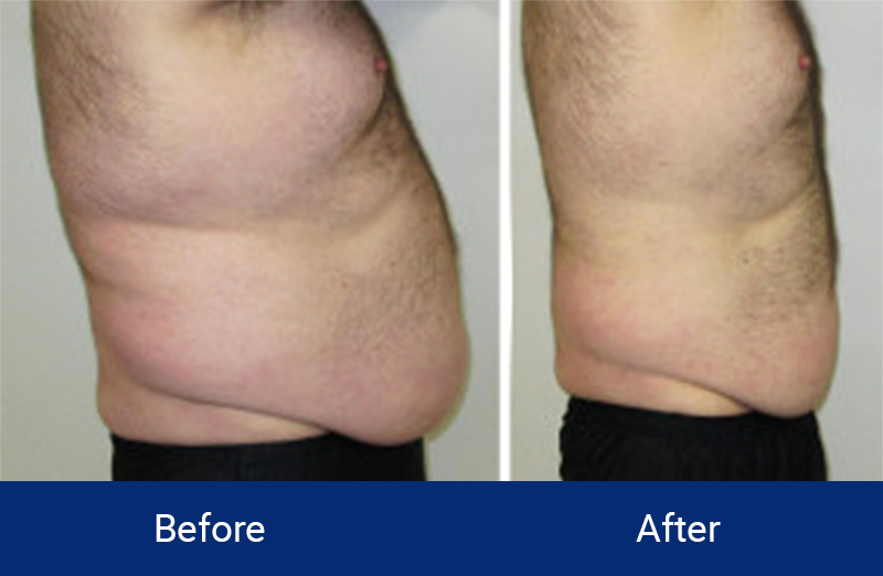 Body Contouring