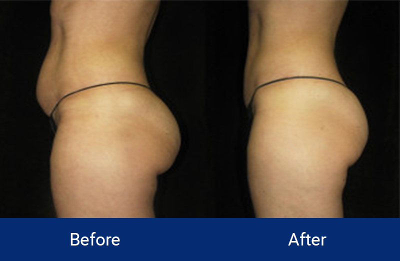 Body Contouring