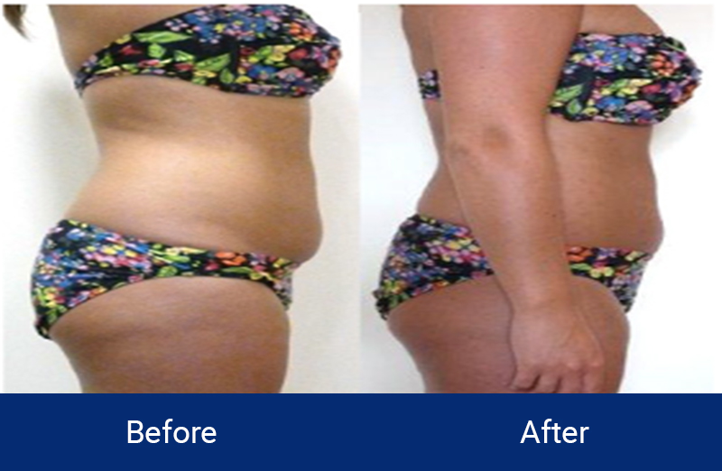 Body Contouring