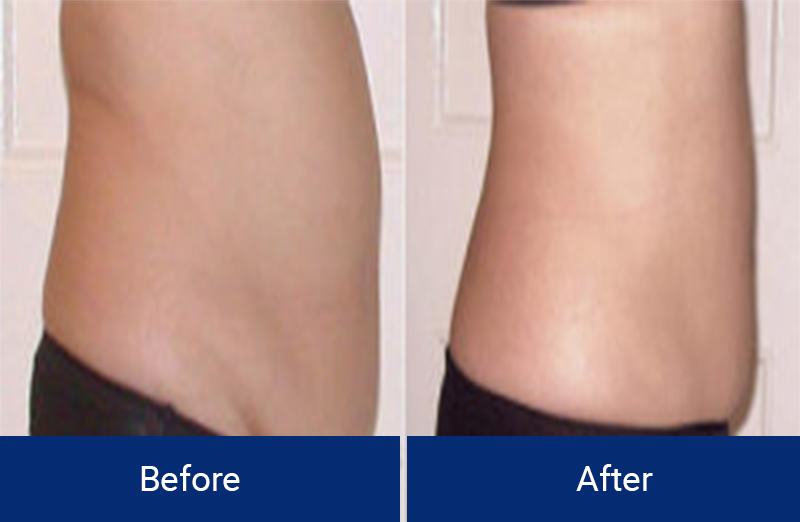 Body Contouring