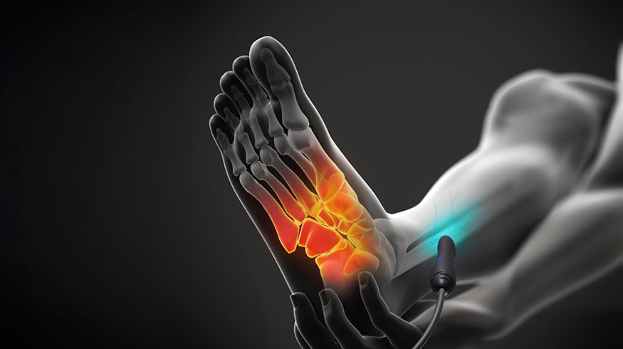stimpod Treatment in foot at Marin Chiropractor