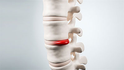 patient needs herniated disc chiropractor in Novato, CA
