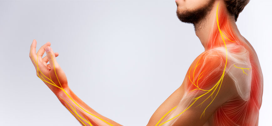 patient needing brachial plexus neuritis treatment in Novato
