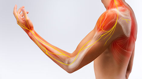patient requiring brachial plexus neuritis treatment in Novato
