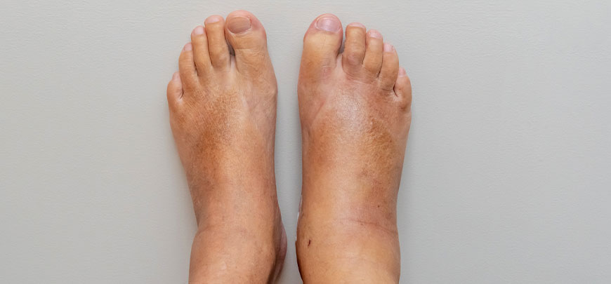 patient needing complex regional pain syndrome treatment in Novato