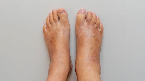 patient requiring complex regional pain syndrome treatment in Novato