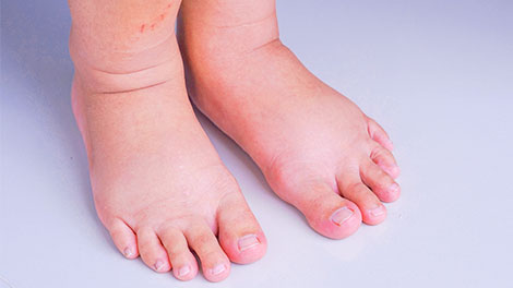 patient requiring diabetic neuropathy treatment in Novato
