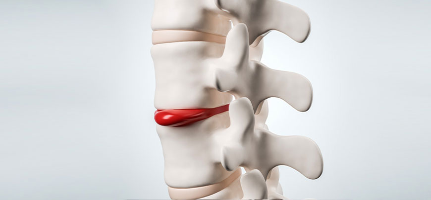 patient receiving herniated disc treatment in Novato