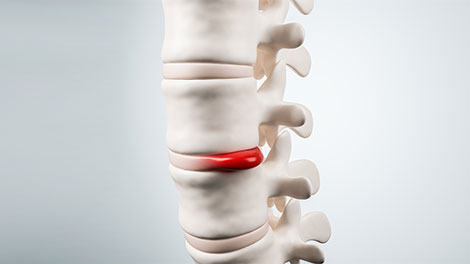 patient requiring disc injury treatment in Novato