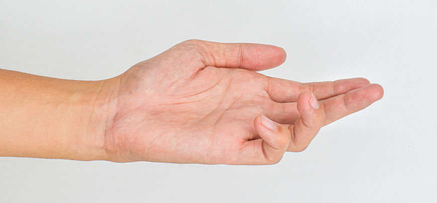patient needing dupuytren contracture treatment in Novato