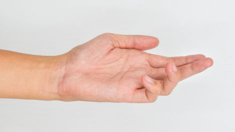 patient requiring dupuytren contracture treatment in Novato