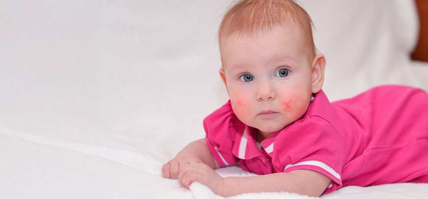 patient needing Eczema treatment in Novato CA