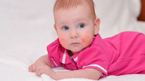 patient requiring eczema treatment in Novato