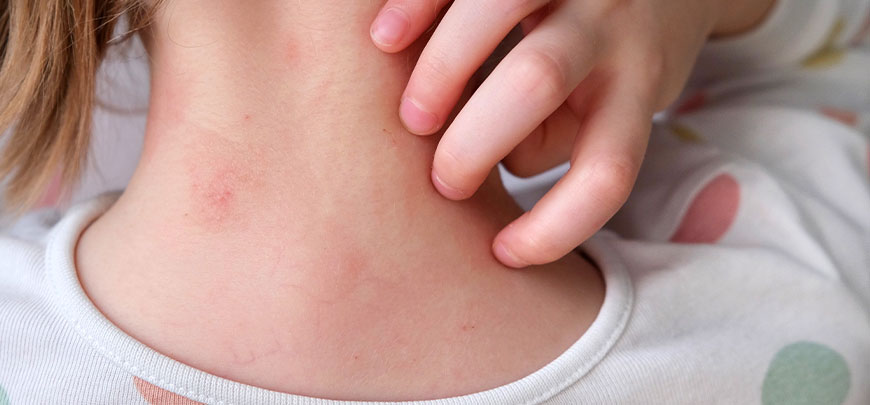 patient needing Frequent Rashes treatment in Novato CA