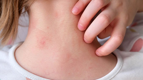 patient requiring frequent rash treatment in Novato