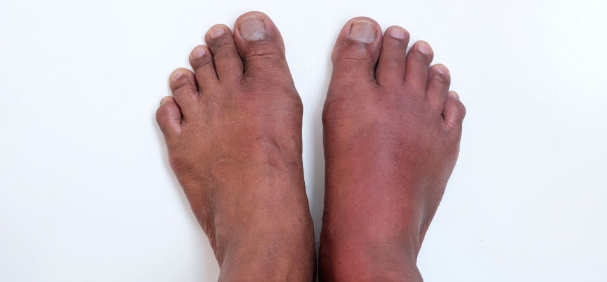 patient needing peripheral neuropathy treatment in Novato