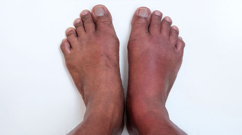 patient requiring peripheral neuropathy treatment in Novato