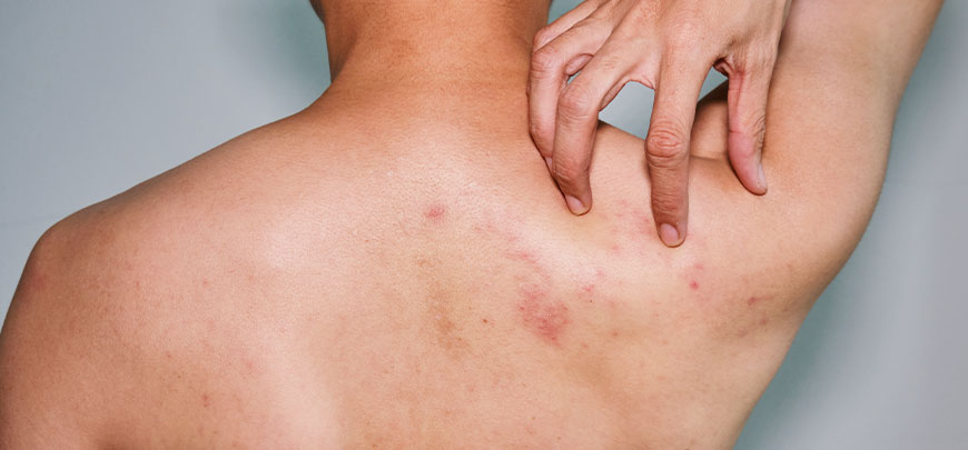 patient needing post-herpetic neuralgia treatment in Novato