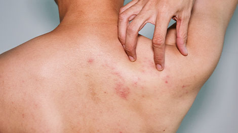 patient requiring post herpetic neuralgia treatment in Novato