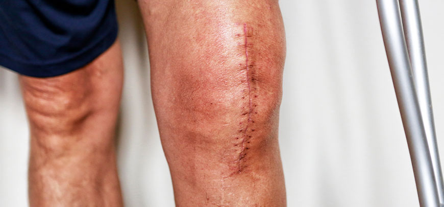 patient needing post-surgical neuropathic pain treatment in Novato
