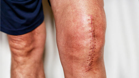 patient requiring post surgical neuropathic pain treatment in Novato