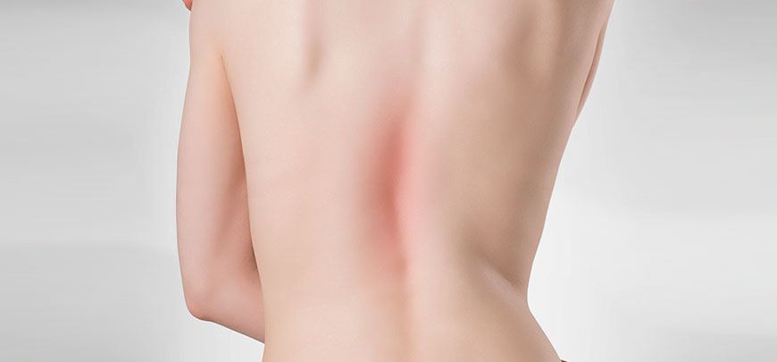 patient needing scoliosis treatment in Novato