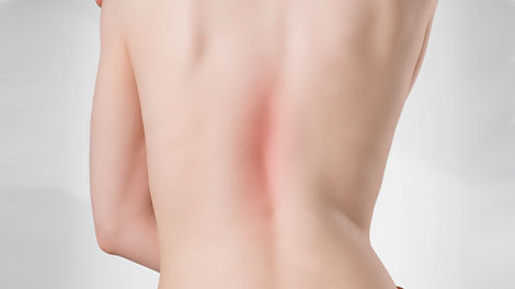 patient requiring scoliosis treatment in Novato