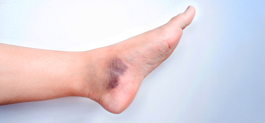patient needing sprain treatment in Novato