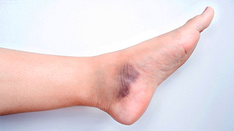 patient requiring sprain treatment in Novato