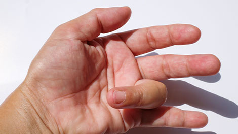 patient requiring trigger finger treatment in Novato